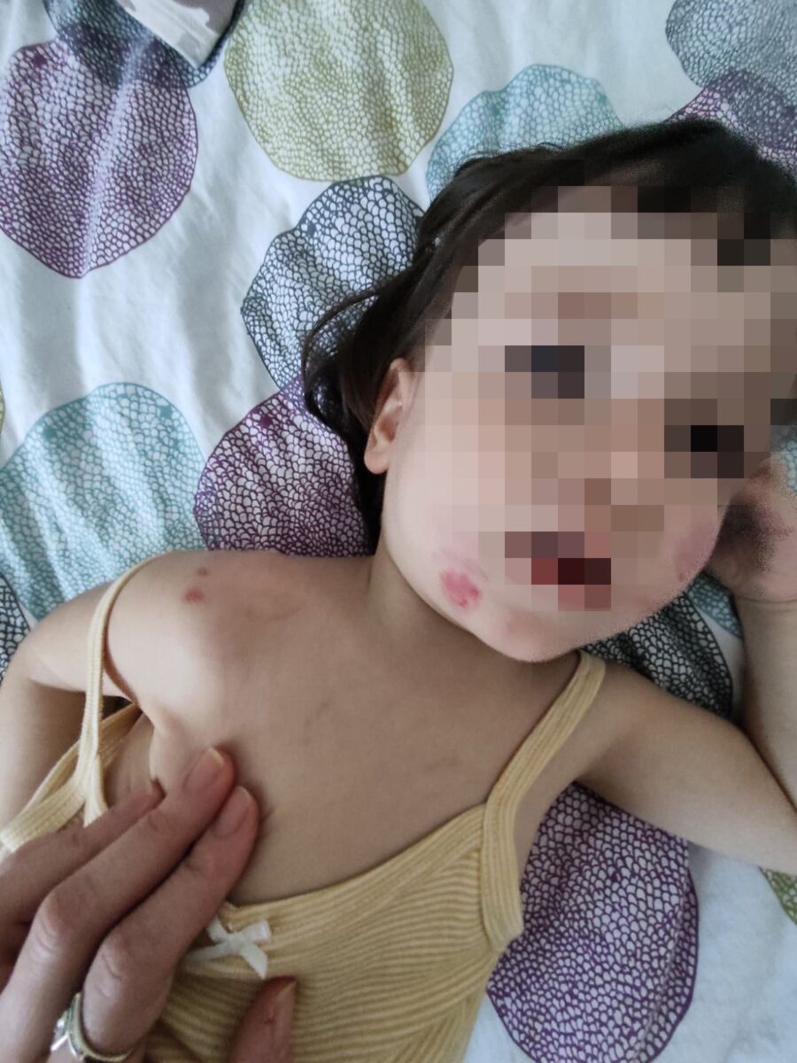 Dijete u sarajevskom vrtiću zadobilo povrede na neutvrđen način: Policija sve istražuje, roditelji tvrde da vrtić sve “zataškava”