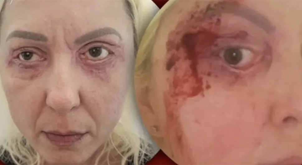 Jadranka iz Bijeljine boluje od rijetke bolesti i treba našu pomoć