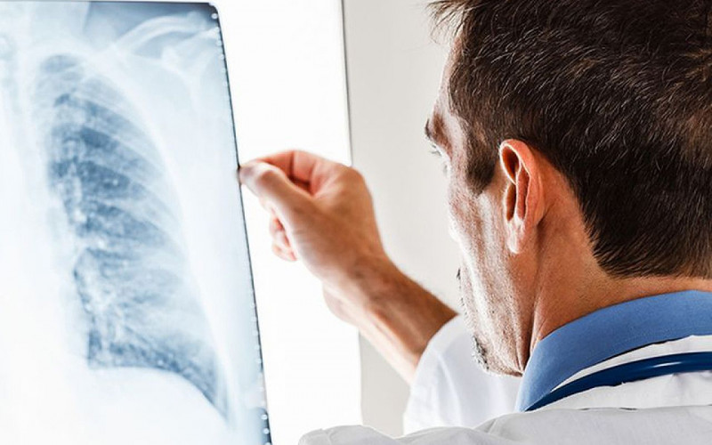 U Srpskoj 194 novooboljelih od tuberkuloze