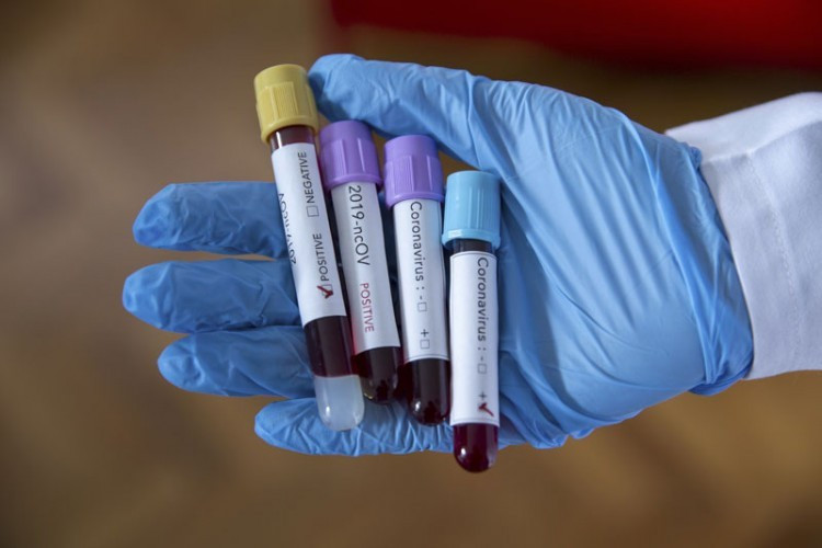 Starija žena iz Teslića preminula, 21 osoba pozitivna na virus korona