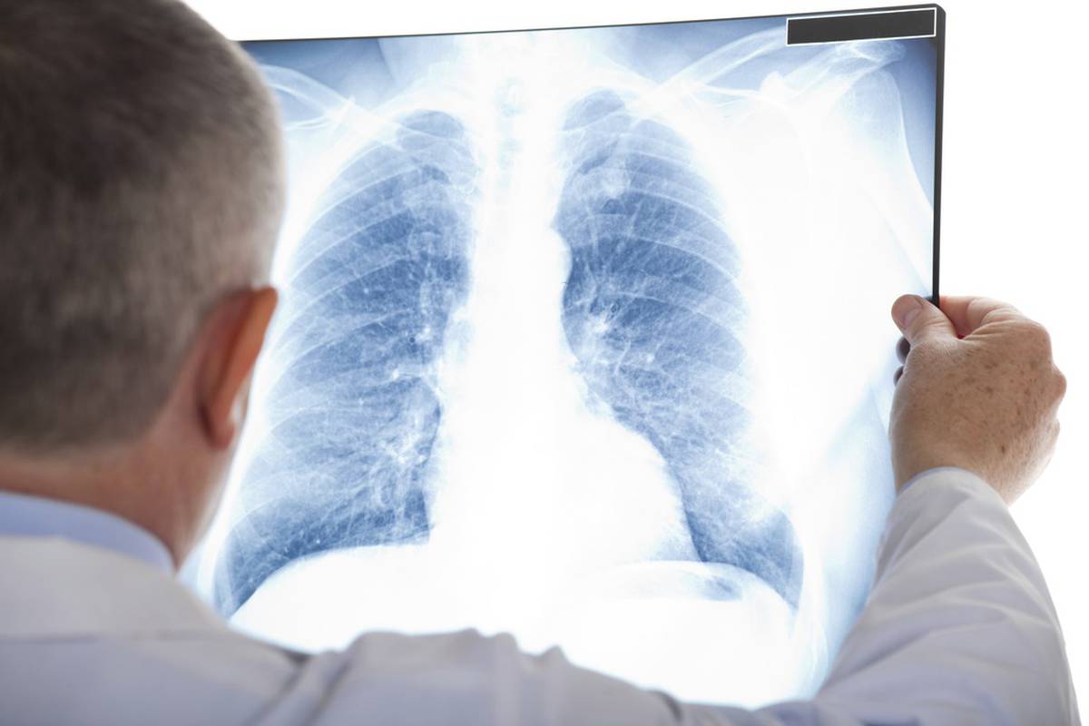Od tuberkuloze za tri godine oboljelo 386 ljudi u Srpskoj