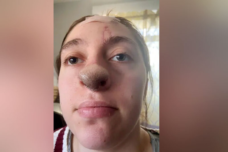 Pas odgrizao nos djevojci, sada joj raste kosa na licu