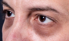 Ovi faktori uzrokuju tamne podočnjake