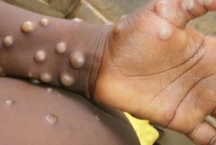 SZO razmatra proglašenje vanredne situacije zbog majmunskih boginja