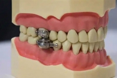 Bizaran uređaj za mršavljenje: Ne da vam da otvorite usta