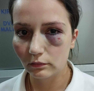 Pretučena radnica hotela Jablanica odbila nagodbu, traži da nasilnik odgovara