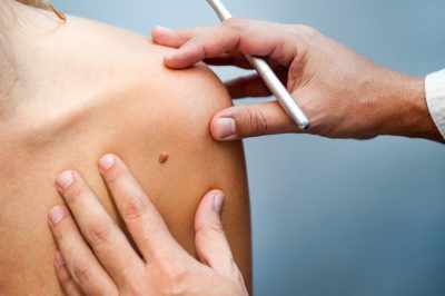 Besplatni pregledi građana u okviru kampanje "Euromelanoma"