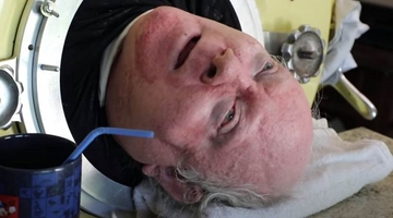 Ne može da diše samostalno od 1952. godine, a nikada nije odustao: 70 godina "živi" u čeličnim plućima