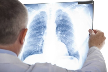 Od tuberkuloze za tri godine oboljelo 386 ljudi u Srpskoj