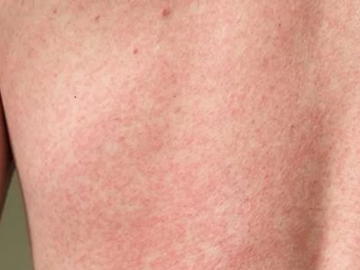 Potvrđen zika virus u regionu